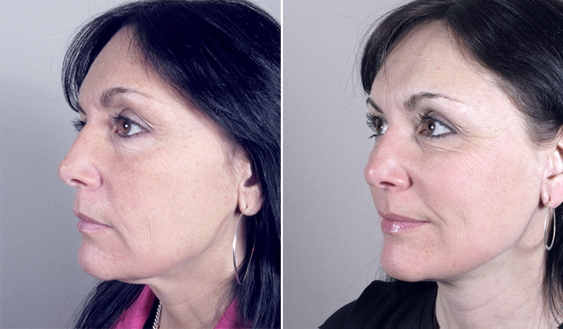 Side view of woman before and after neck lift