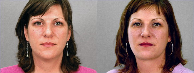 Side view of woman\'s neck before and after liposuction