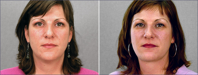 vista Lateral da mulher\'s no pescoço, antes e após a lipoaspiração's neck before and after liposuction