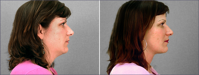 Front view of woman\'s neck before and after liposuction