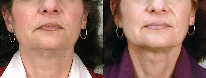 vista Frontal de mulher\'s no pescoço, antes e depois de pescoço elevador's neck before and after neck lift