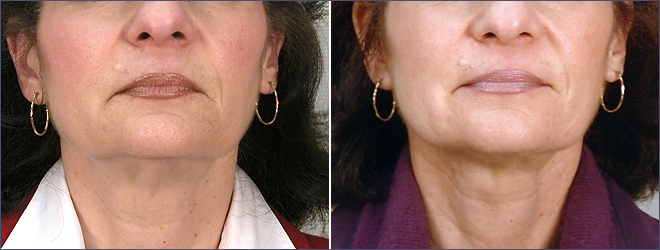 Front view of woman\'s neck before and after neck lift