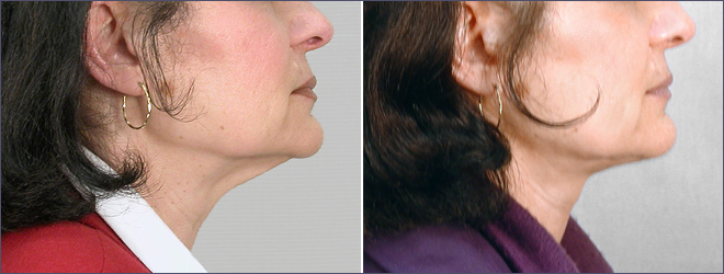 Side view of woman\'s neck before and after neck lift