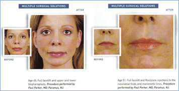 Before and after facelift featured in New Beauty magazine