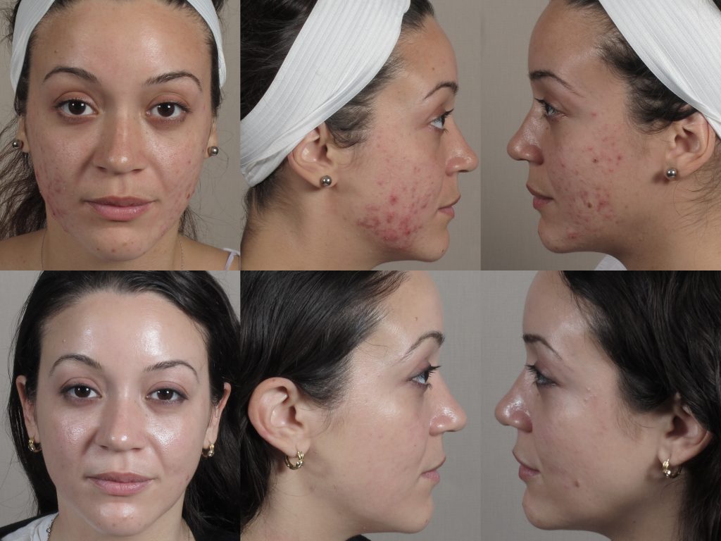 Young woman shown before and after acne treatment