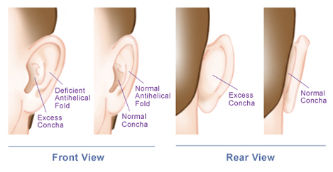 Concerns corrected with otoplasty