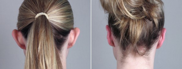 Otoplasty New Jersey Image