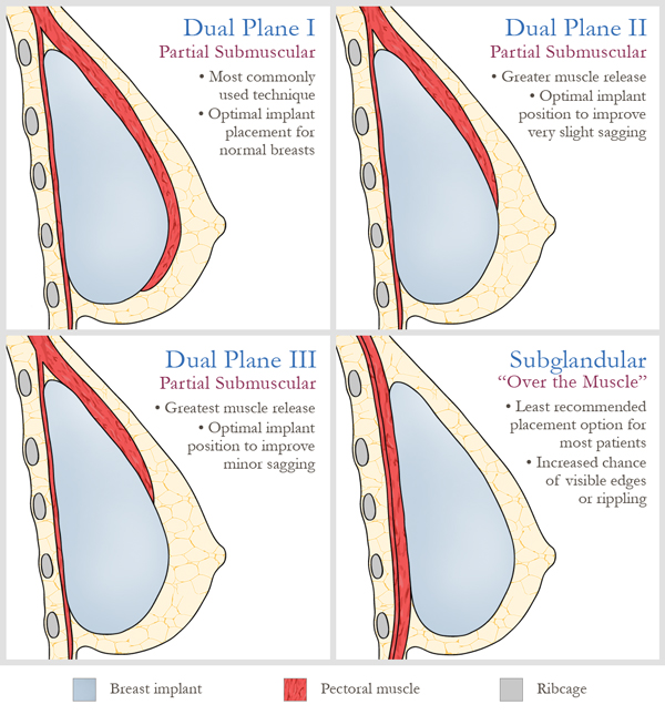 Implant placement diagram showing implant varying degrees under the chest muscle and completely on top of the chest muscle