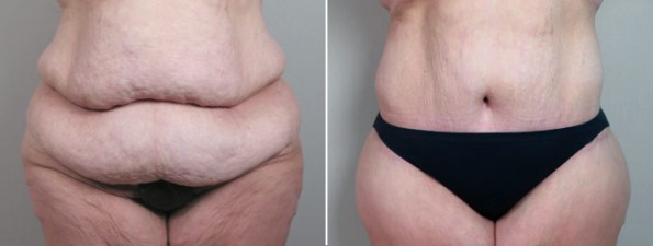 New Jersey Body Lift