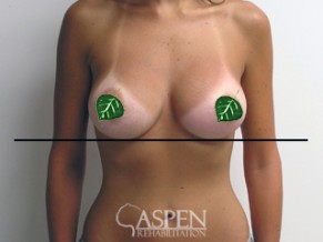 Woman\'s breasts after Aspen therapy