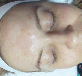 Rezenerate after sun damage