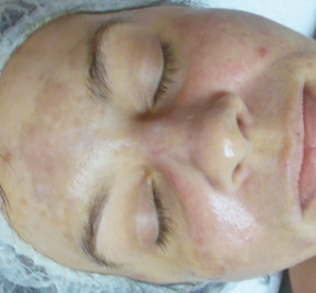 Rezenerate before sun damage