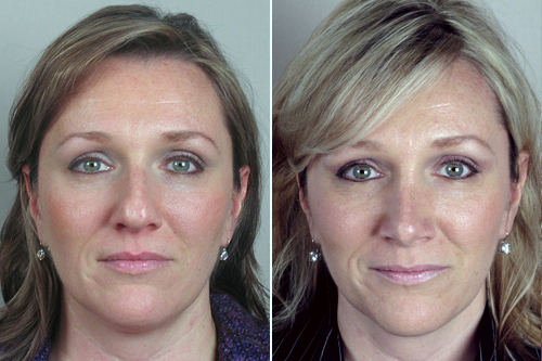 Front view of woman before and after rhinoplasty