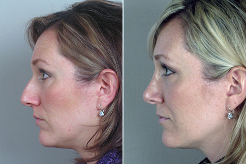 Side view of woman before and after rhinoplasty