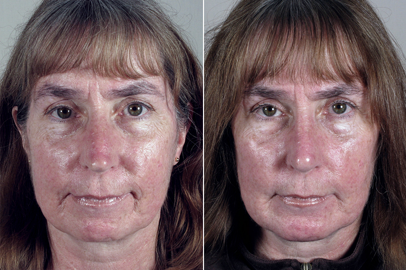 Front view of woman before and after rhinoplasty