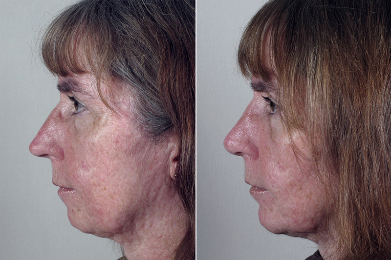 Side view of woman before and after rhinoplasty