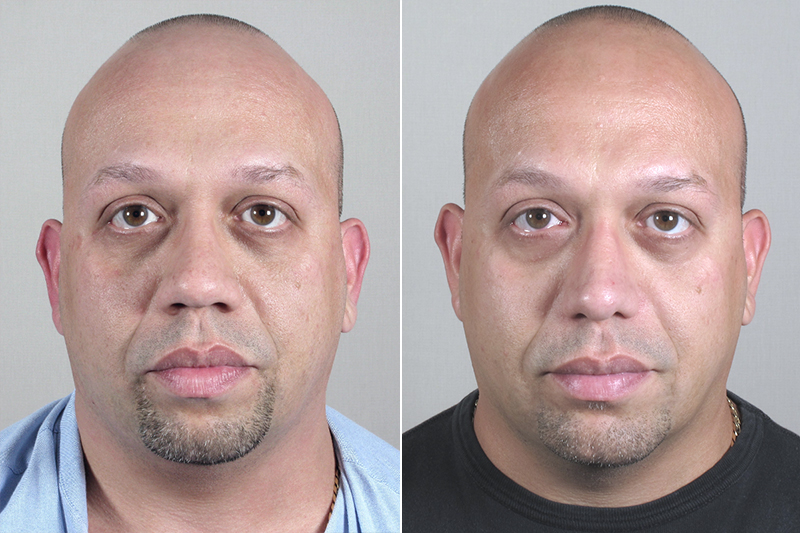 Front view of man before and after rhinoplasty with chin implant