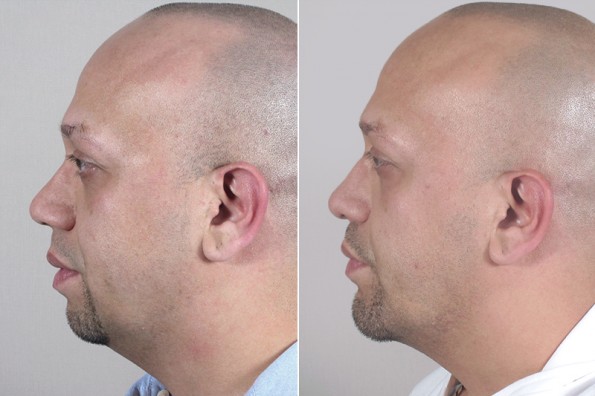 Rhinoplasty New Jersey Image