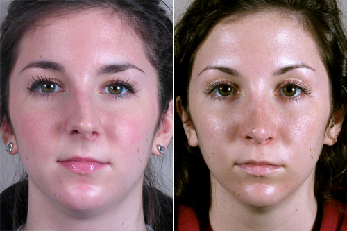 Front view of young woman before and after rhinoplasty