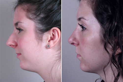 Side view of young woman before and after rhinoplasty