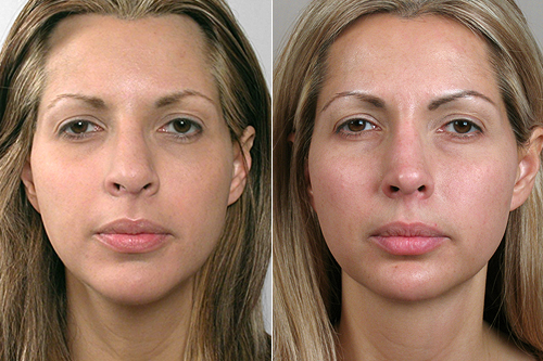 Front view of woman before and after rhinoplasty