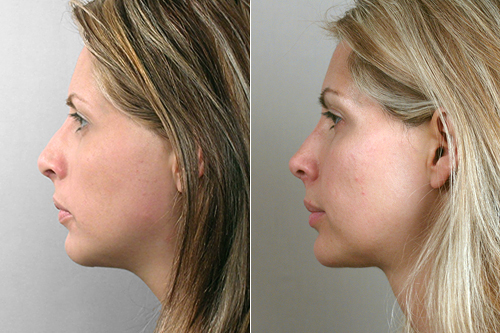 Side view of woman before and after rhinoplasty