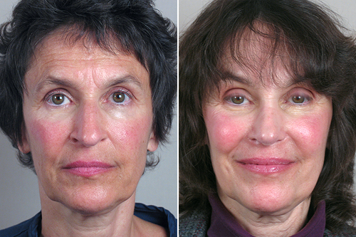 Front view of woman before and after rhinoplasty