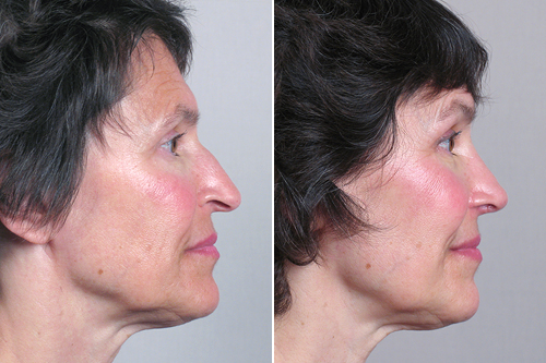 Side view of woman before and after rhinoplasty