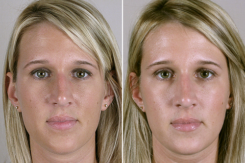Front view of woman before and after rhinoplasty