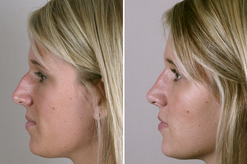 Side view of woman before and after rhinoplasty