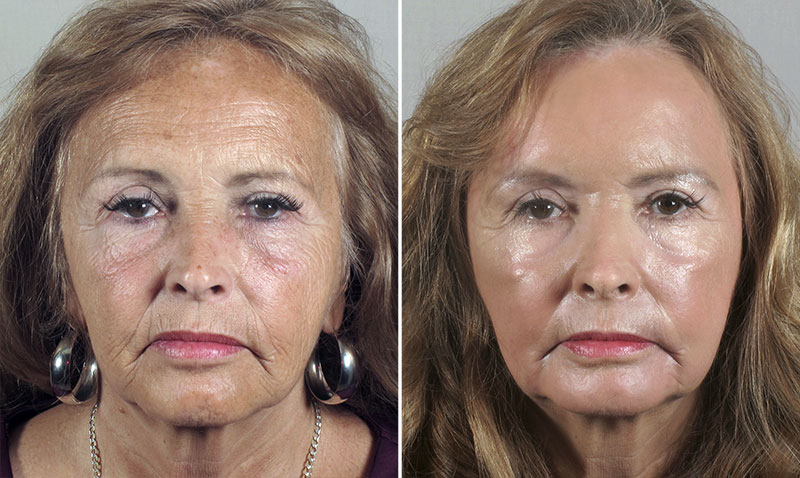 Chemical Peel New Jersey Image