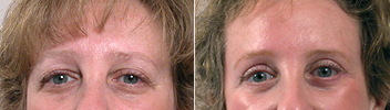 New Jersey Eyelid Surgery