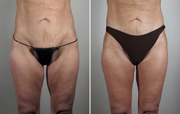 Before and After Thigh lift by Dr. Parker