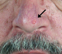 Basal skin cancer on a patient\'s nose