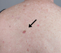 Skin cancer on a patient\'s back