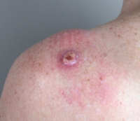 Skin cancer on a patient\'s shoulder