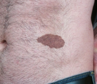Compound nevus on a patients abdomen