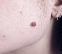 Melanocytic nevus on a patient\'s cheek