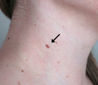 Skin cancer on a patient\'s neck