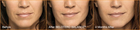Woman's smile lines before, after, and 4 months after Belotero injections