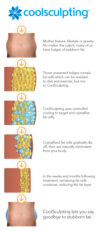 CoolSculpting works by freezing fat cells that are flushed out of the body leaving the treated area slimmer
