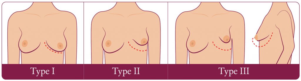 Three degrees of tuberous breast deformity showing the breast smaller and higher with increased degree