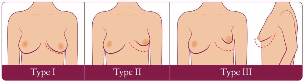 Dr Craig Layt - Tuberous breasts are a congenital abnormality of the breasts  and can be characterised by breasts that appear more conical in shape, as  opposed to round. While not a