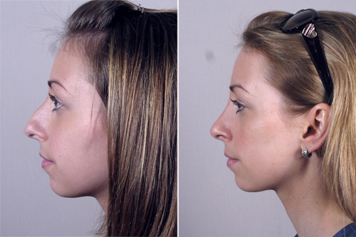 Rhinoplasty New Jersey Image