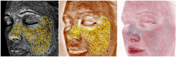 VISIA complexion analysis output