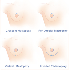 Breast lift incision options are around the upper nipple, all the way around the nipple, around the nipple and down to the breast crease, and around the nipple, down to and along the breast crease