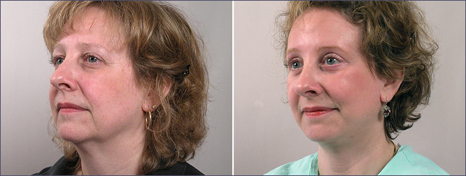 Woman before and after Facelift, Browlift, and lower lid blepharoplasty