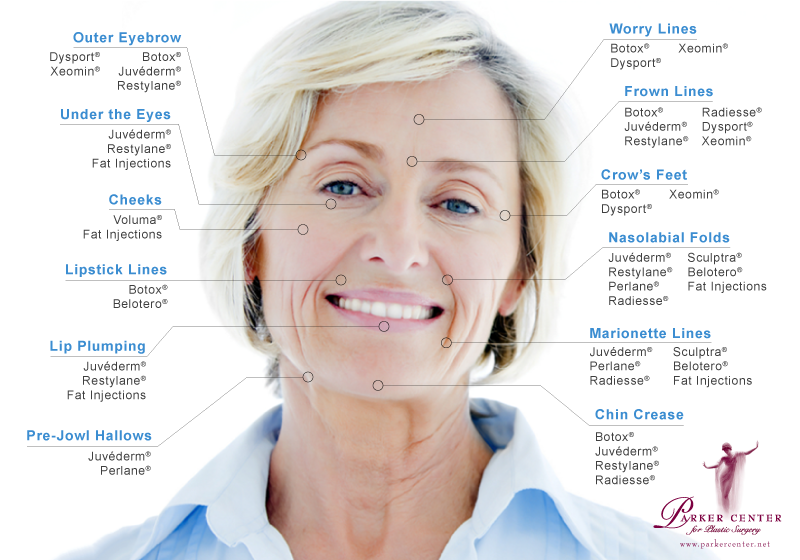 Woman's face showing areas that can be improved with filler injections