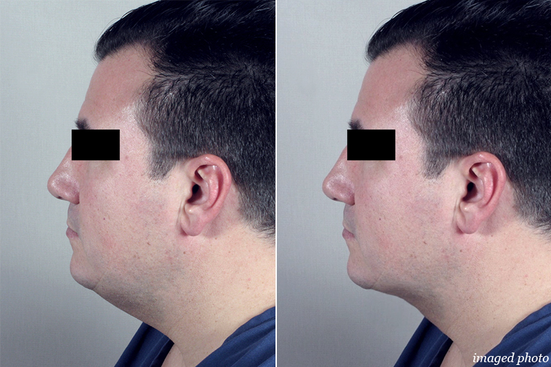 Male computer imaging for neck contouring