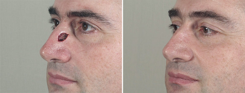 Man\'s face before and after skin cancer repair on his nose